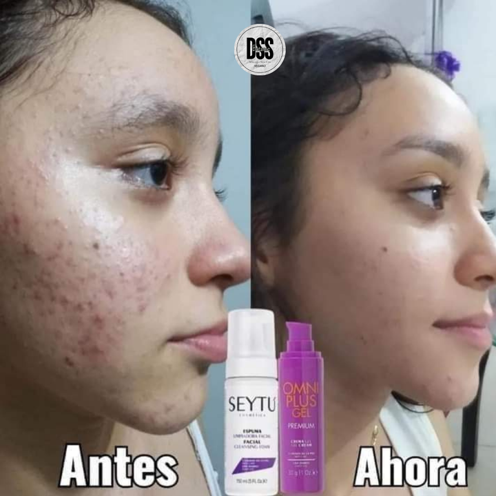 KIT ANTI ACNÉ 😍